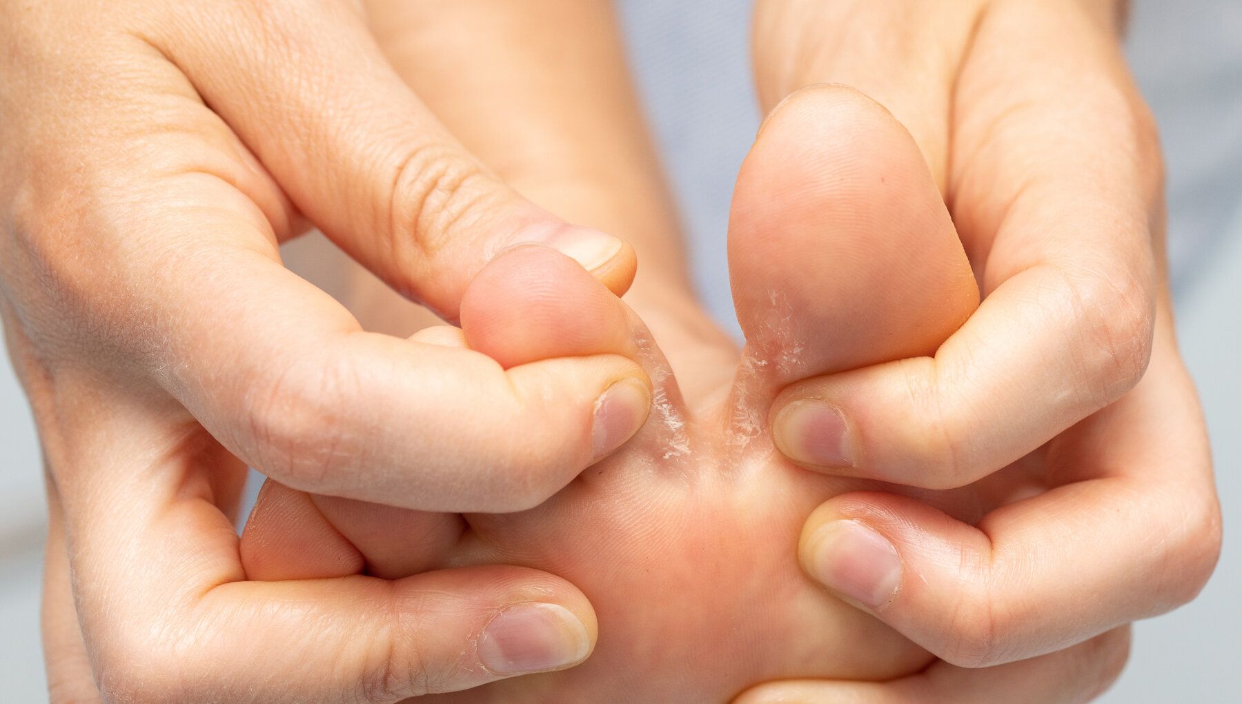 Athlete's Foot
