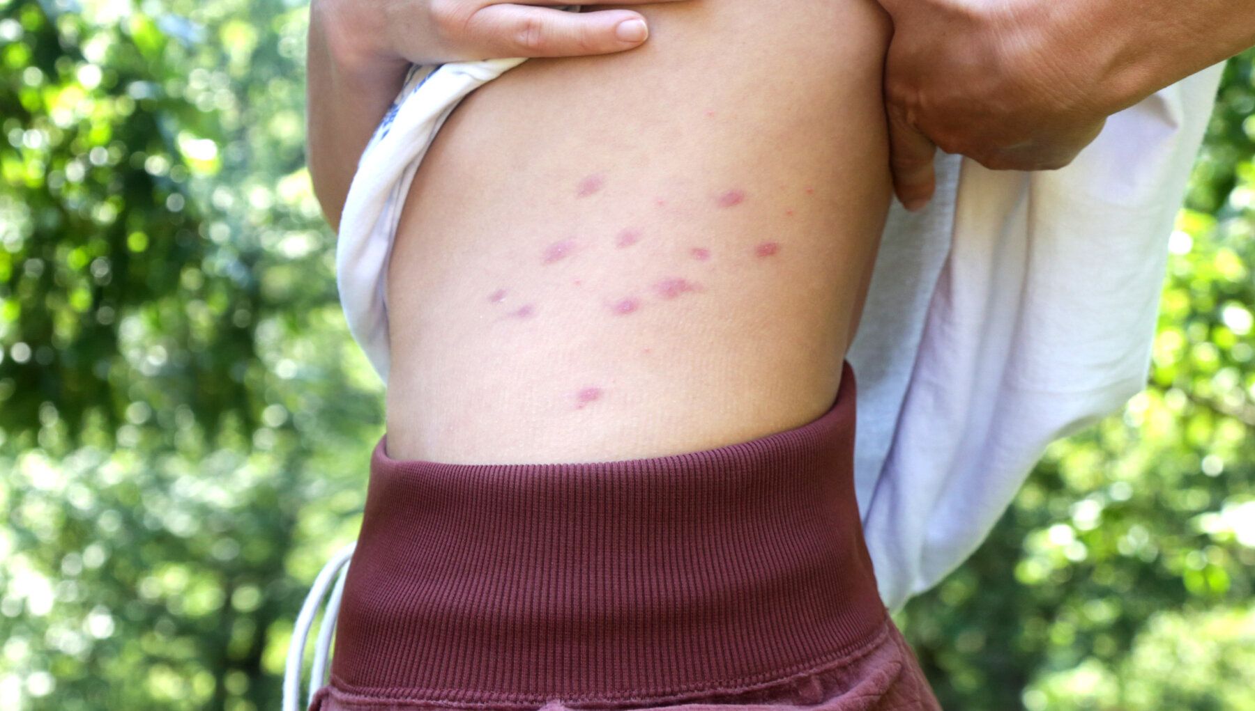 Bed Bugs