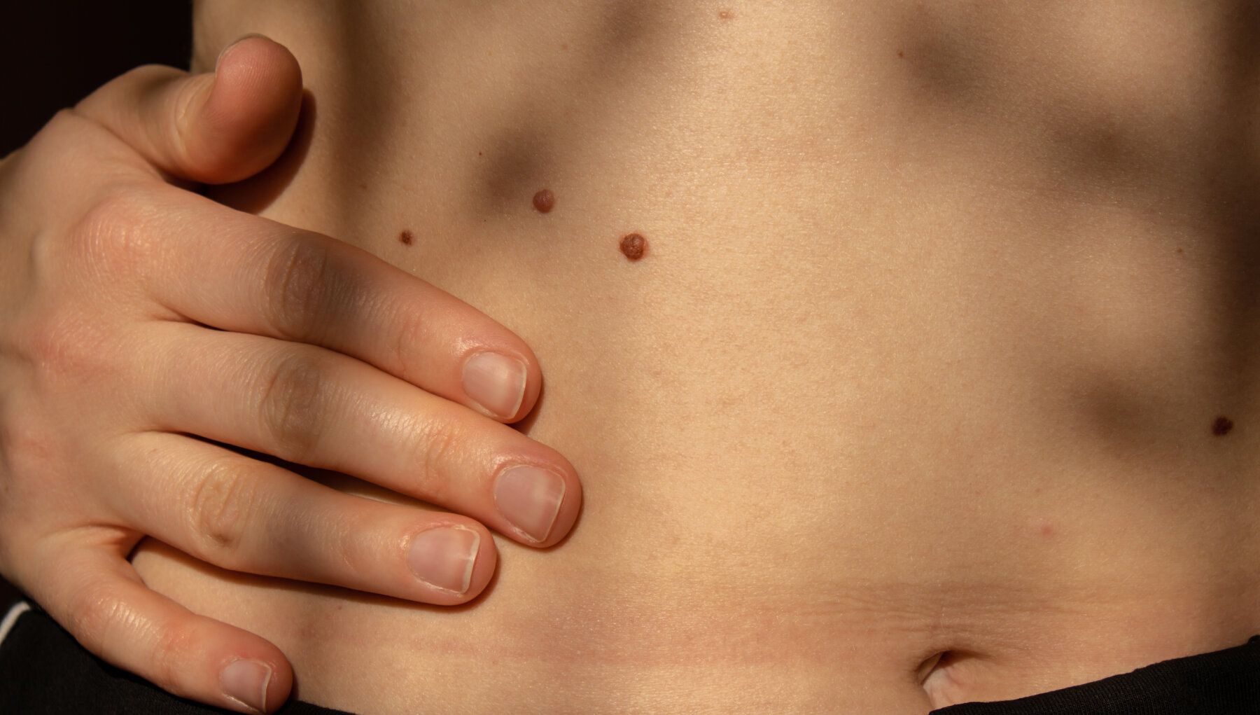 Benign Skin Lesion Removal