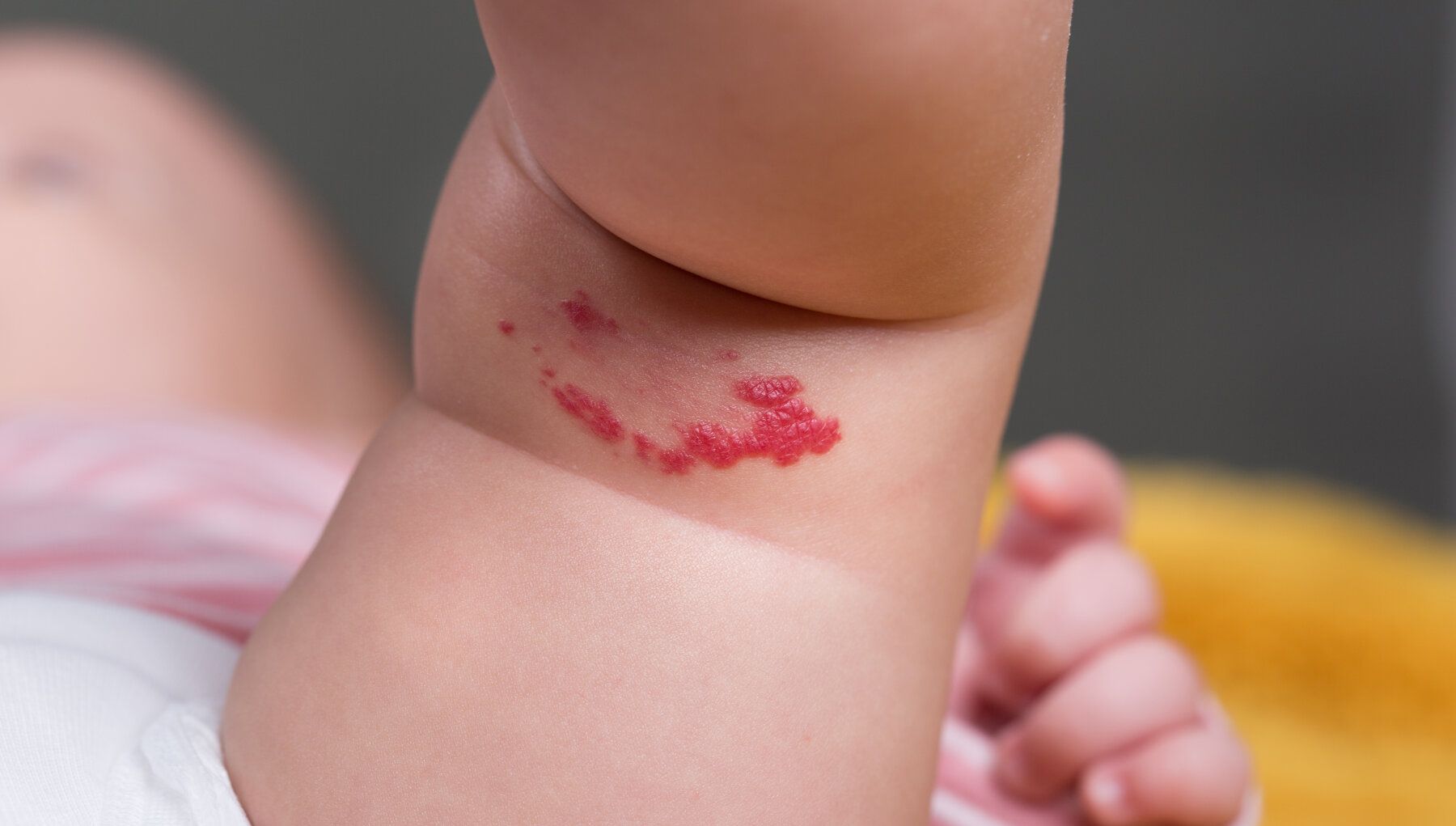 birthmark-treatment
