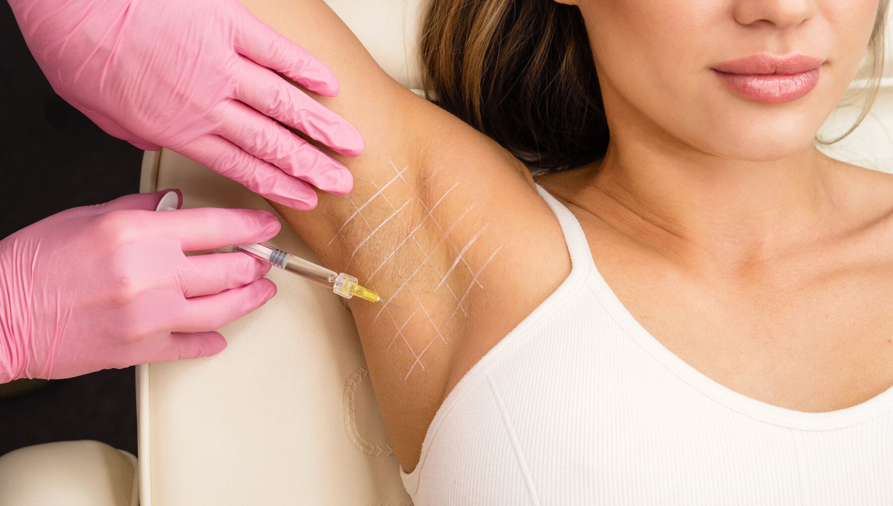 Botox® for Hyperhidrosis