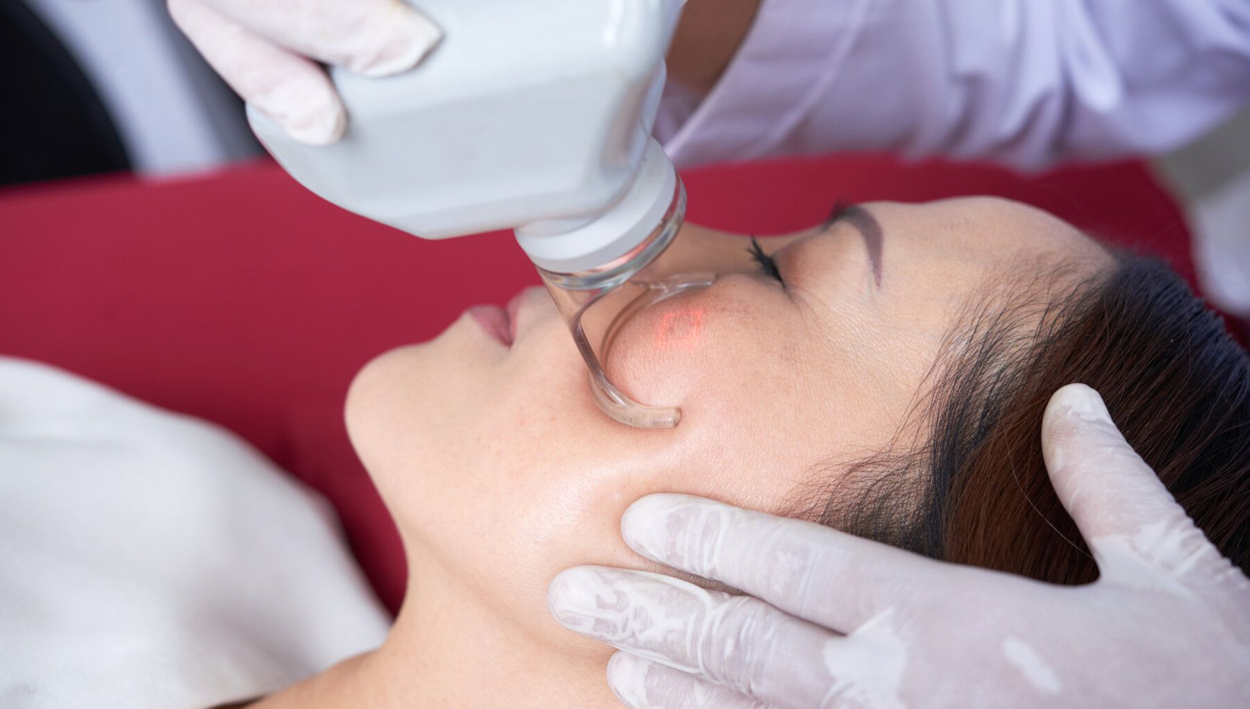 Candela Frax Pro® Laser