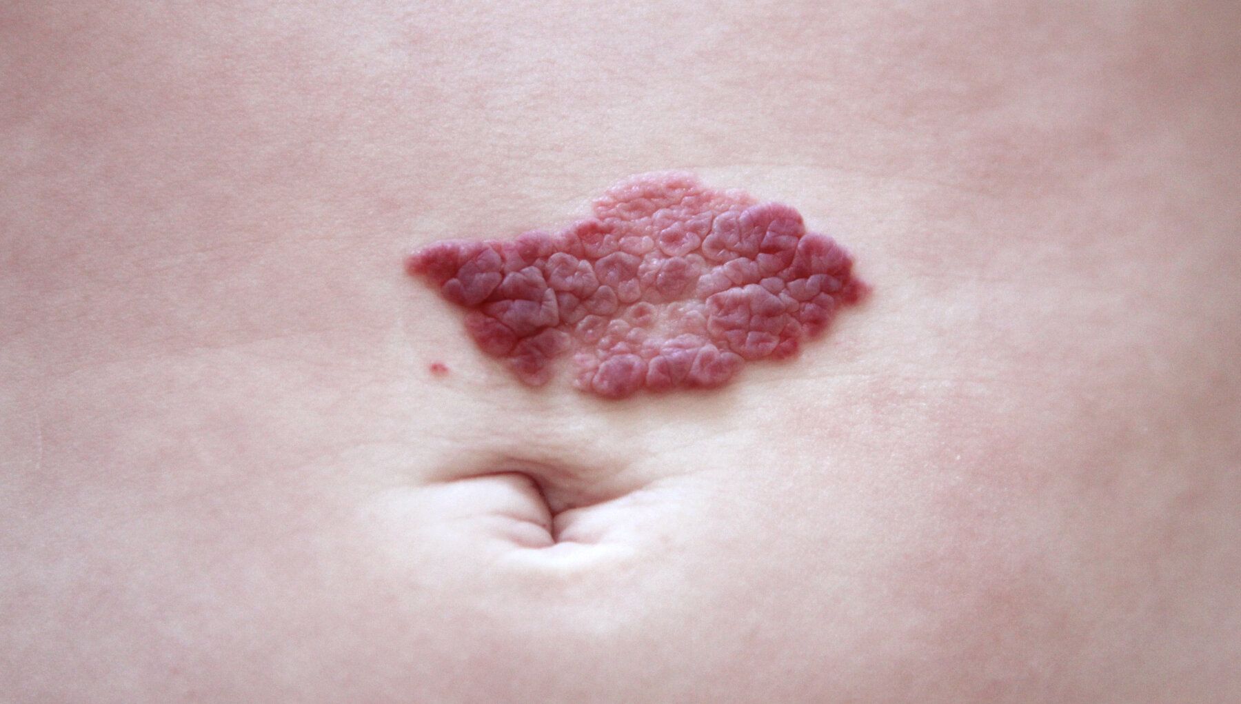 Hemangiomas