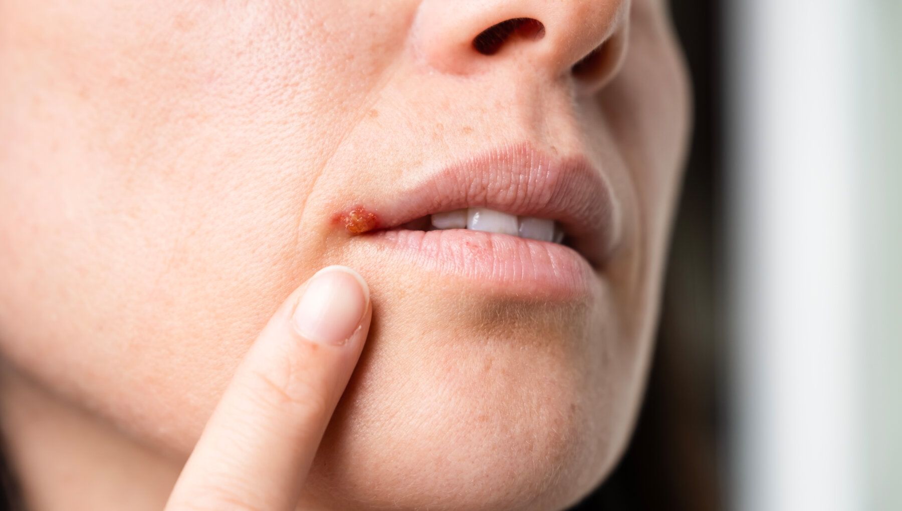 Herpes Simplex
