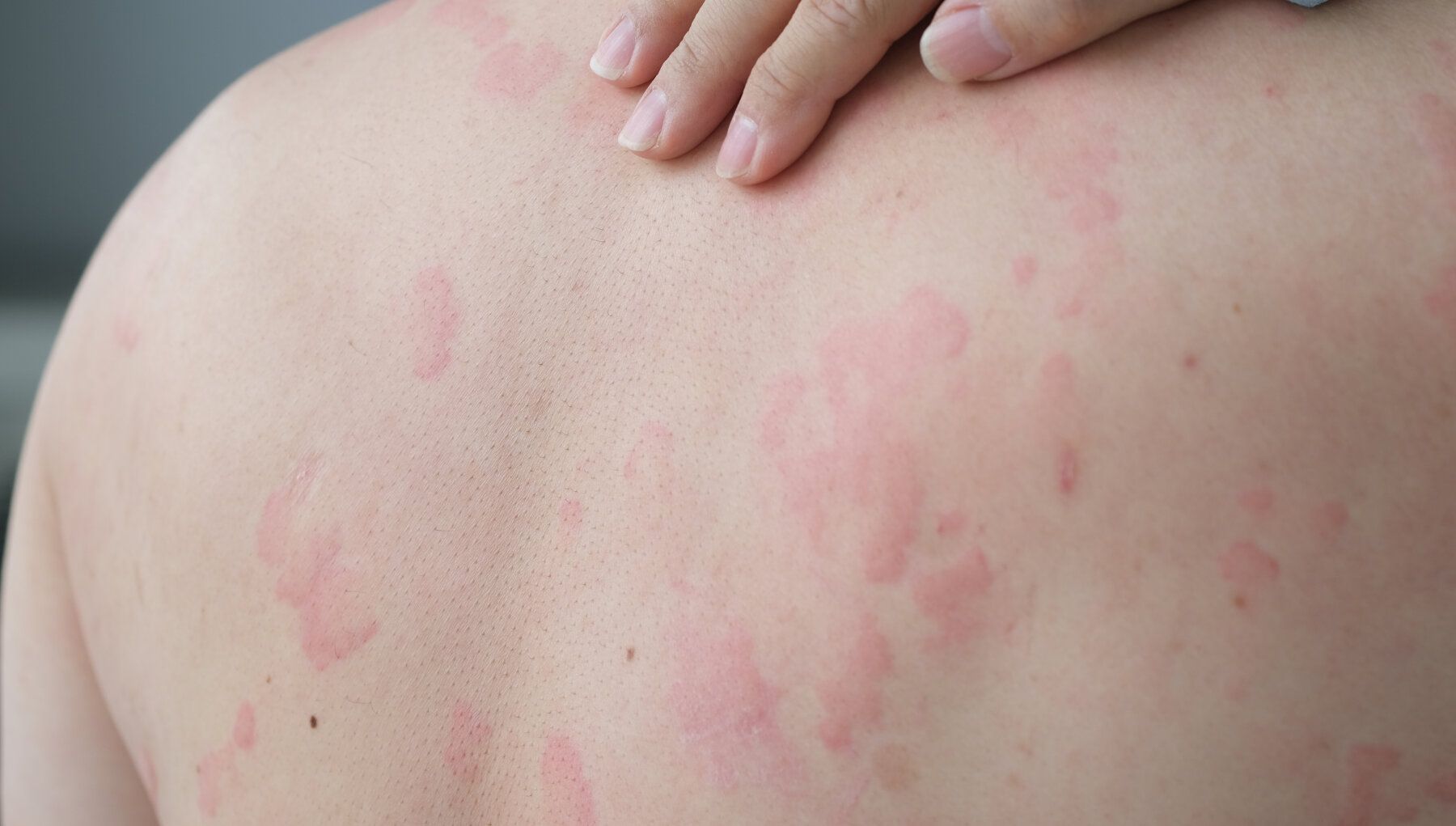 Hives