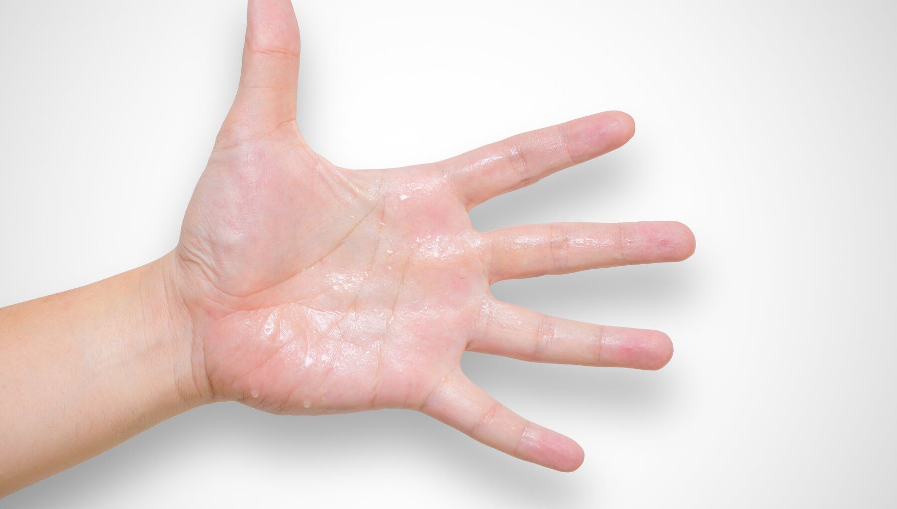 Hyperhidrosis