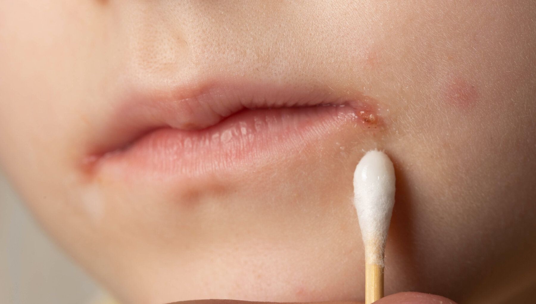 Impetigo