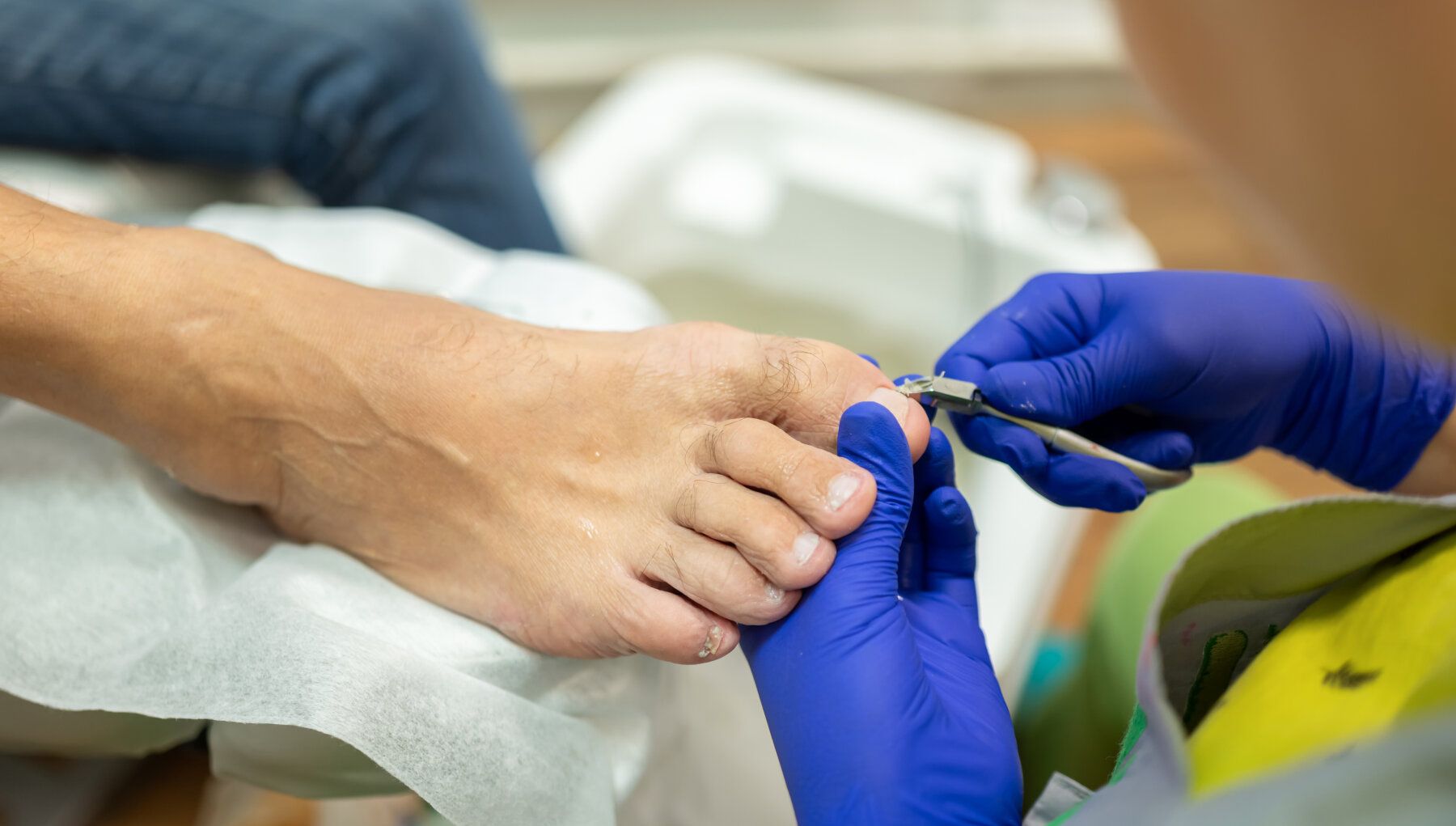 Ingrown Nails