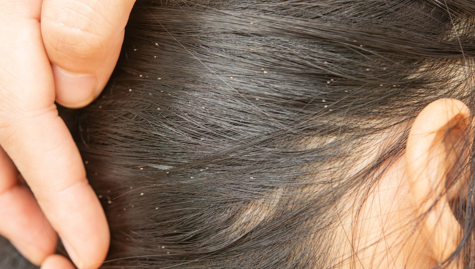Lice