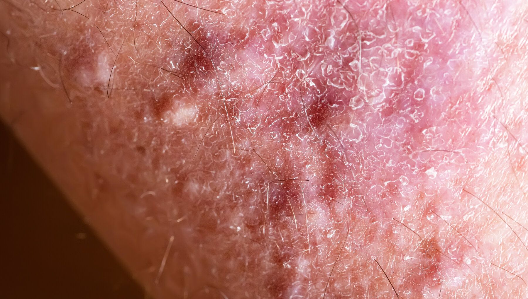 Lichen Planus