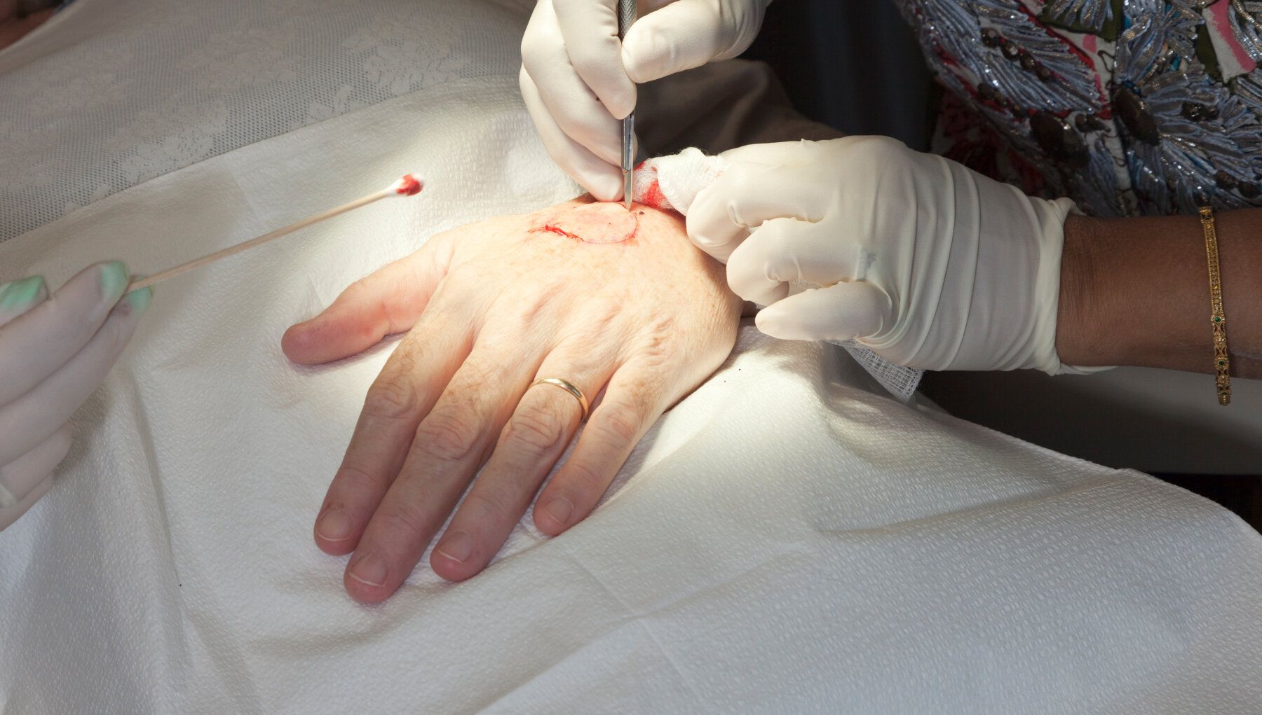 Mohs Surgery
