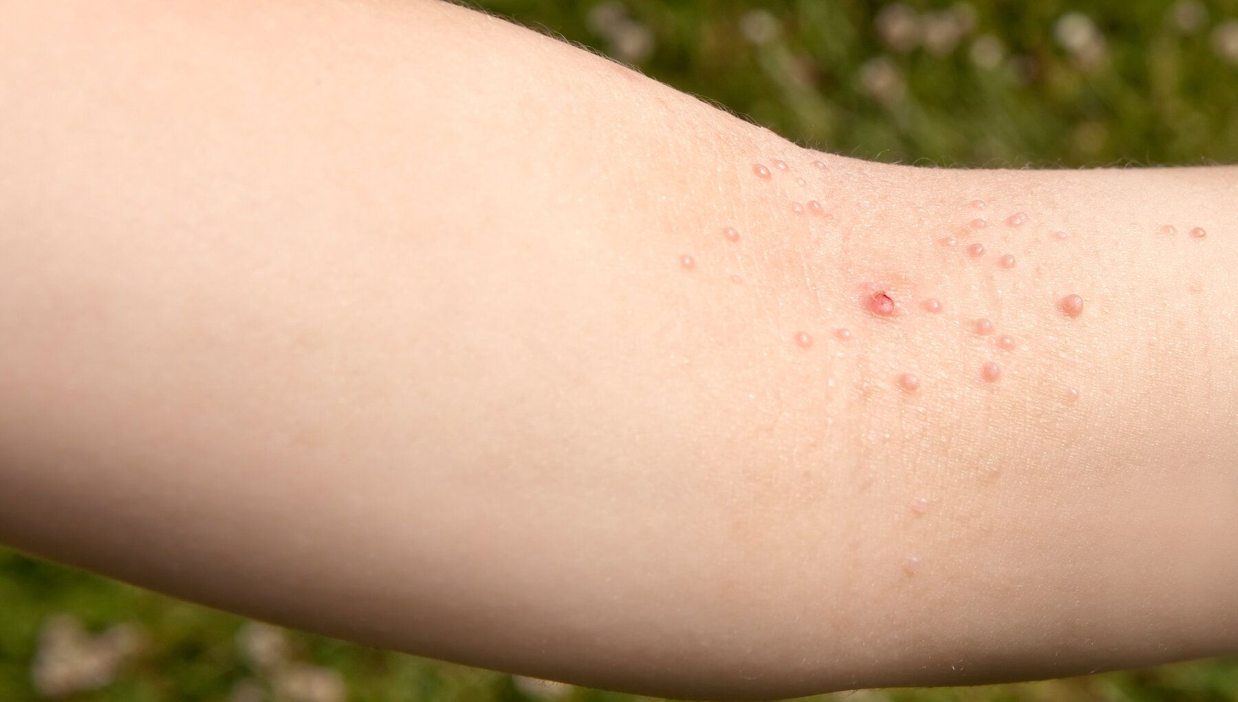 Molluscum Contagiosum