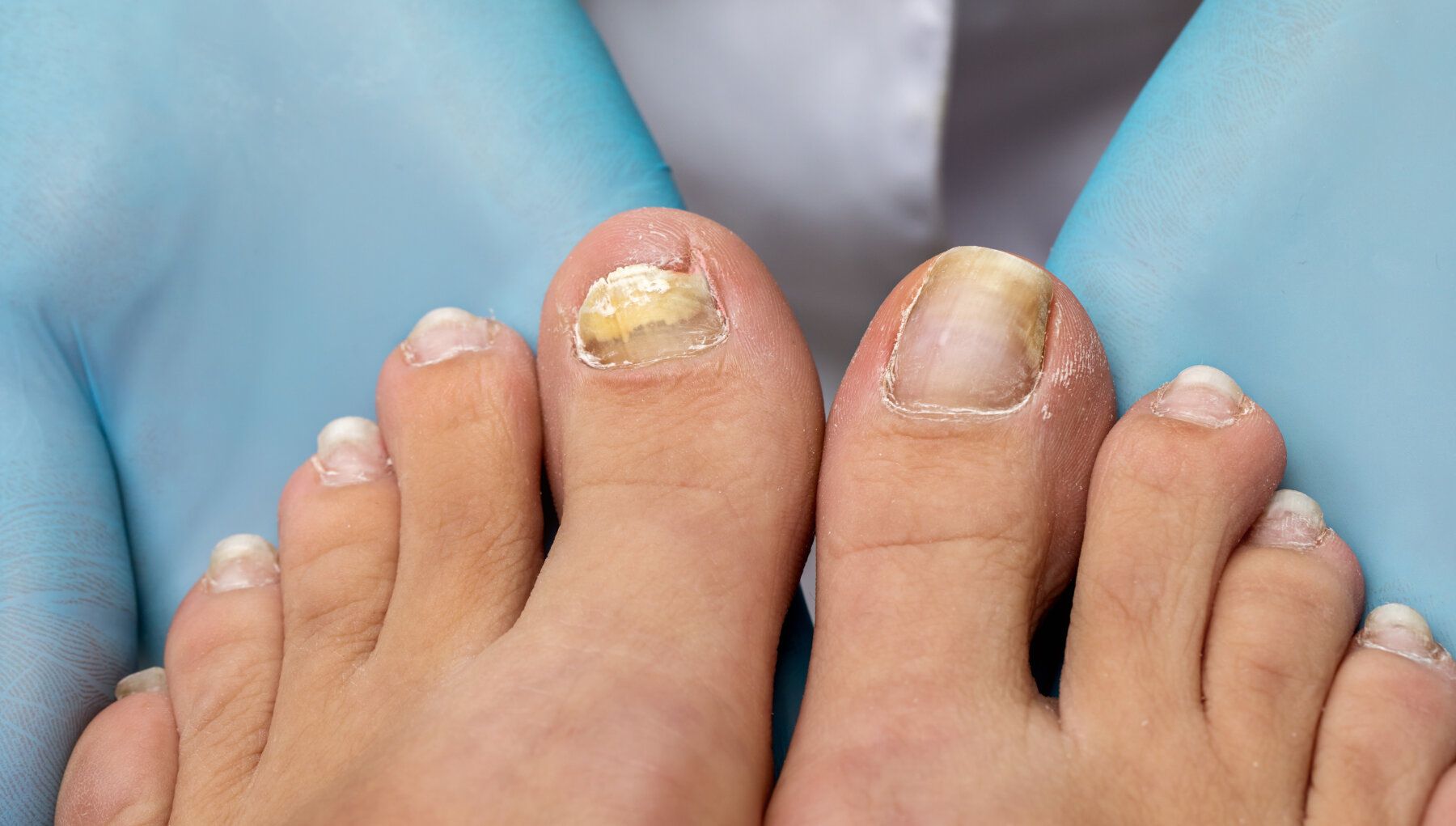 Nail Fungus