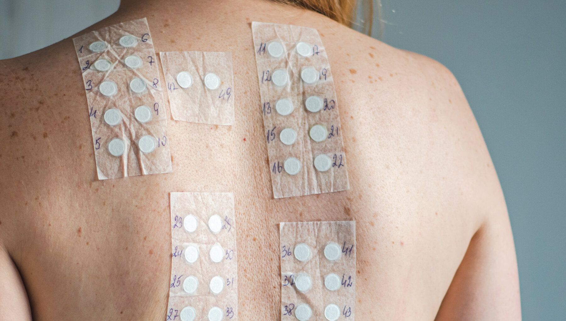 Patch Testing