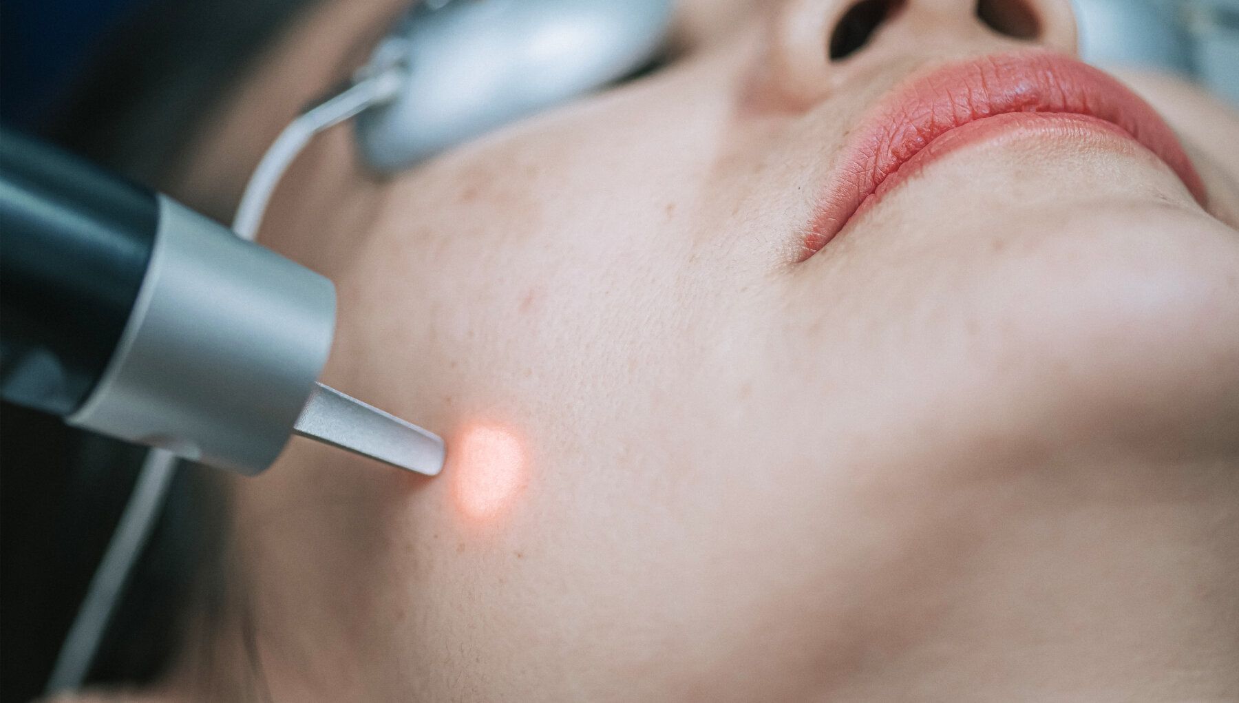 PicoToning Laser