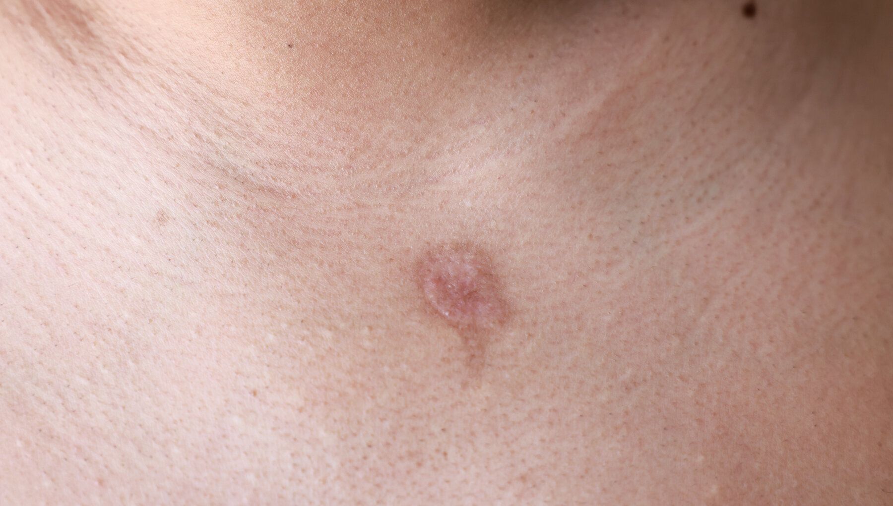 Pityriasis Rosea