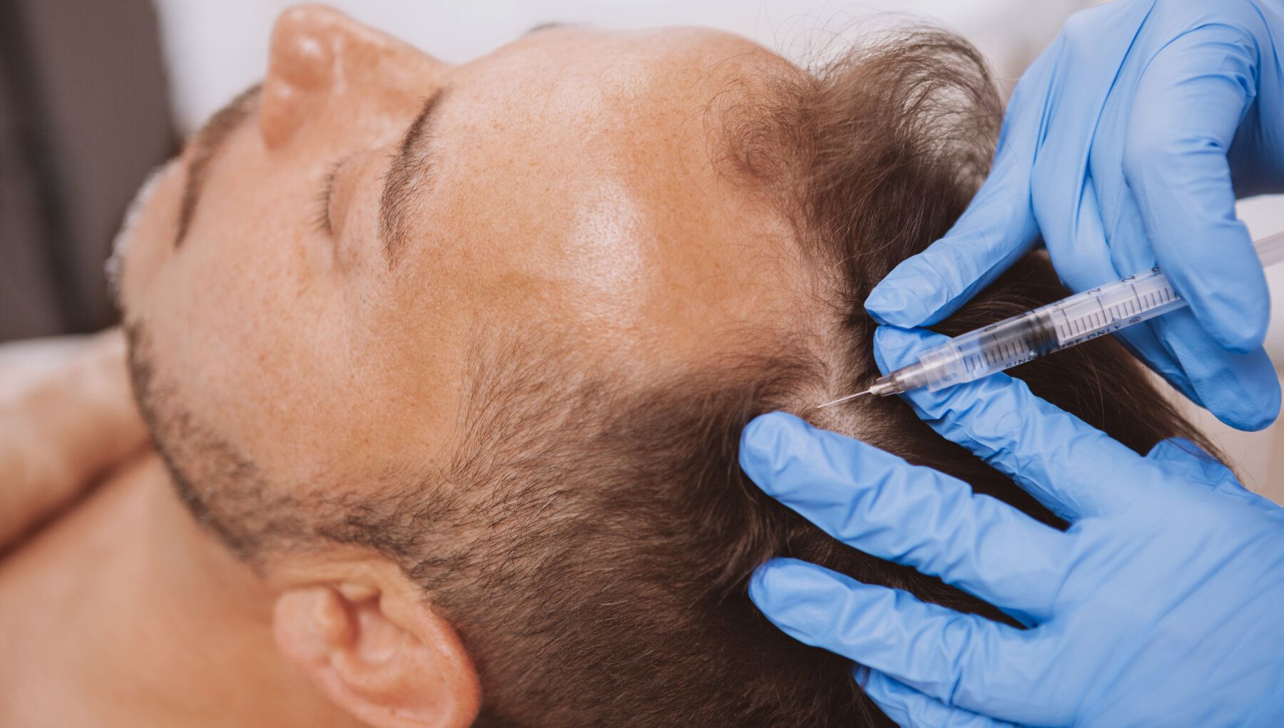 PRP for Hair Loss