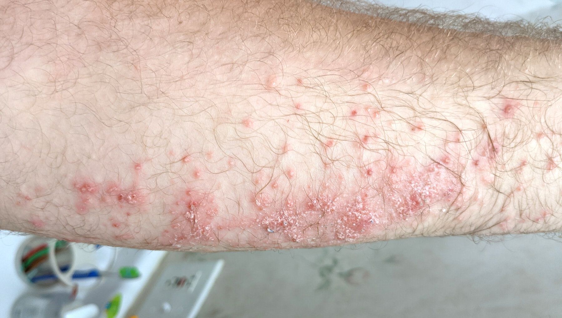 Poison Ivy Rash