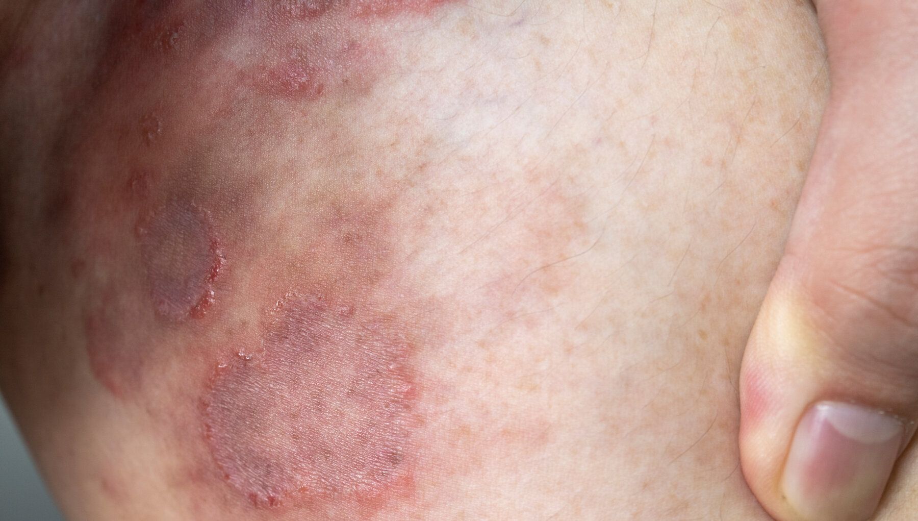 Ringworm