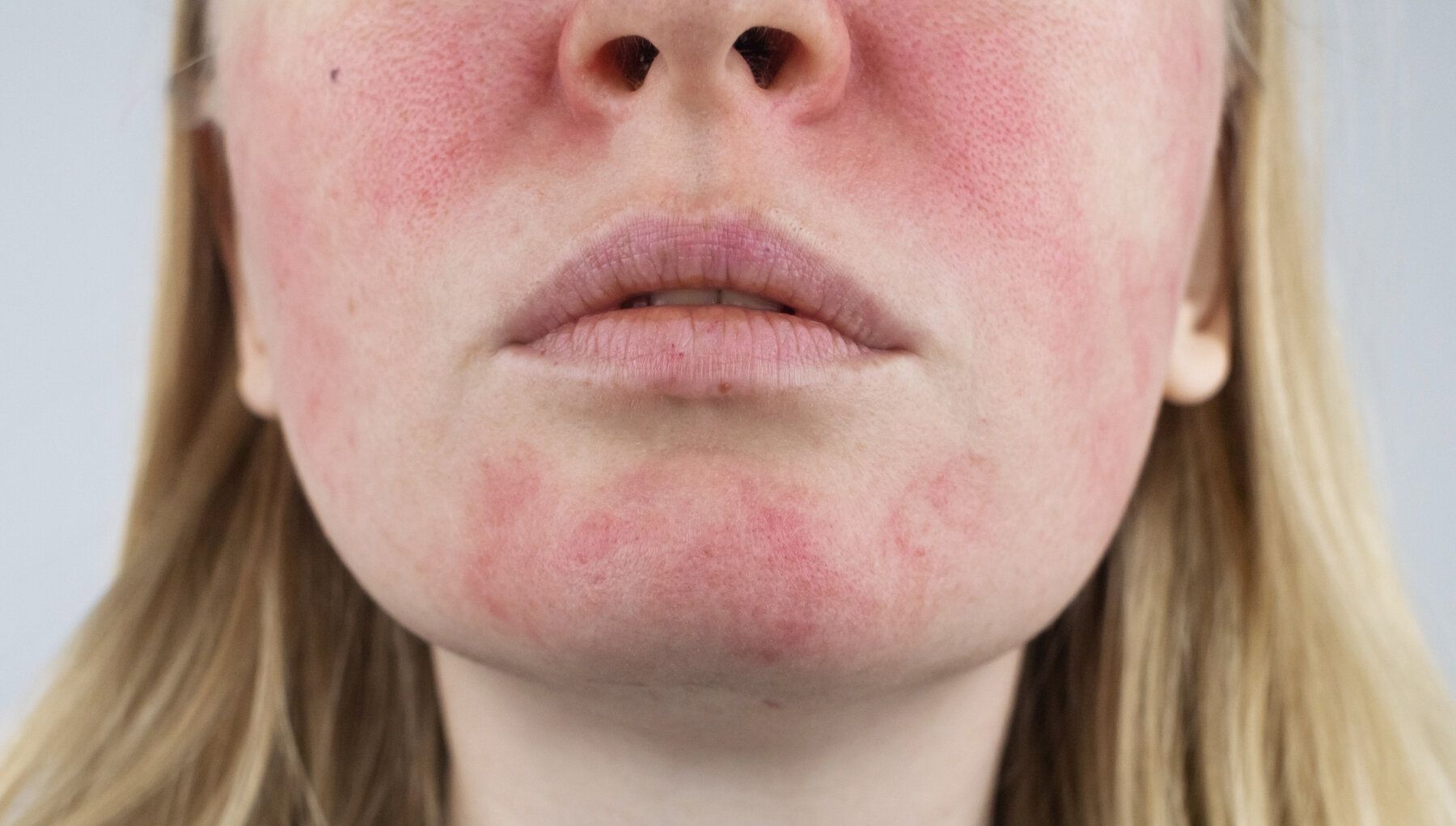 Rosacea