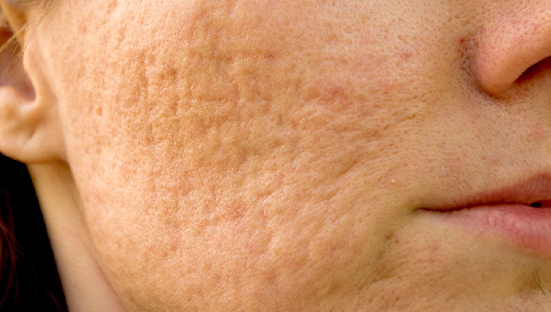 Scar Subcision and Punch Elevation