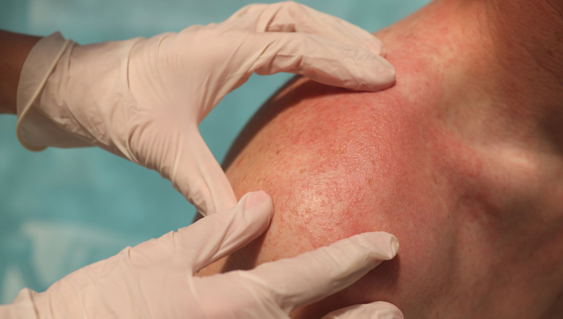 Scleroderma