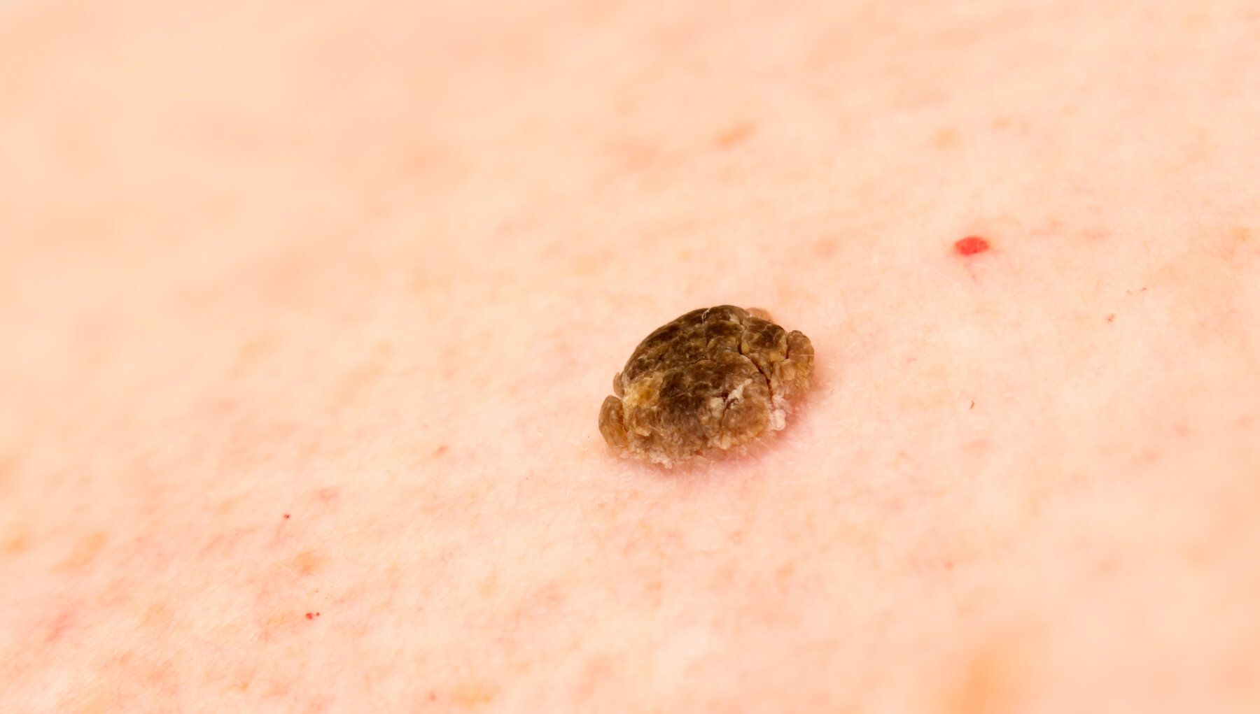 Seborrheic Keratosis