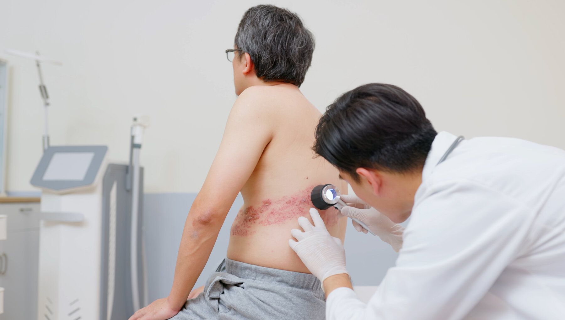 Shingles