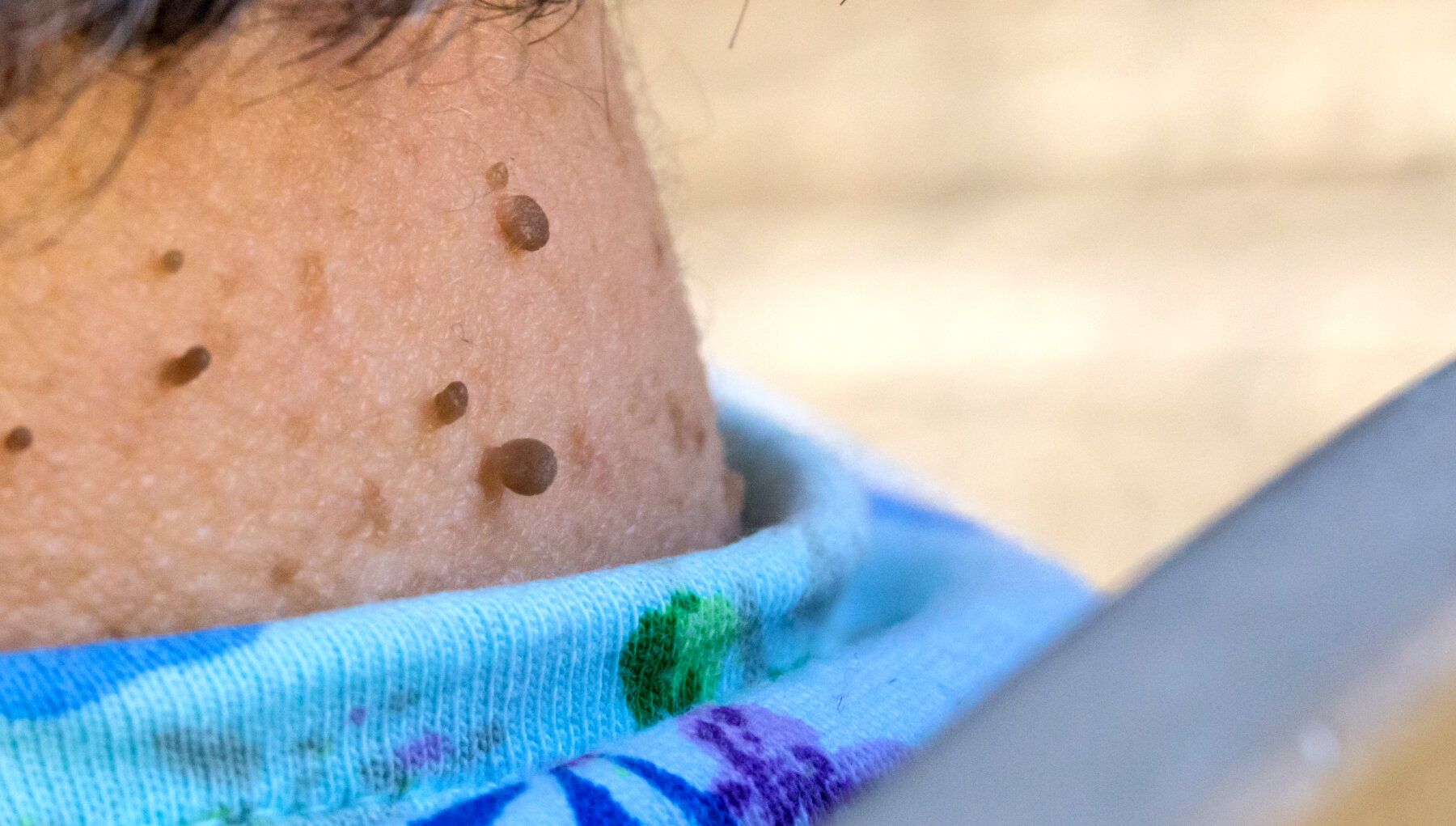 Skin Tags