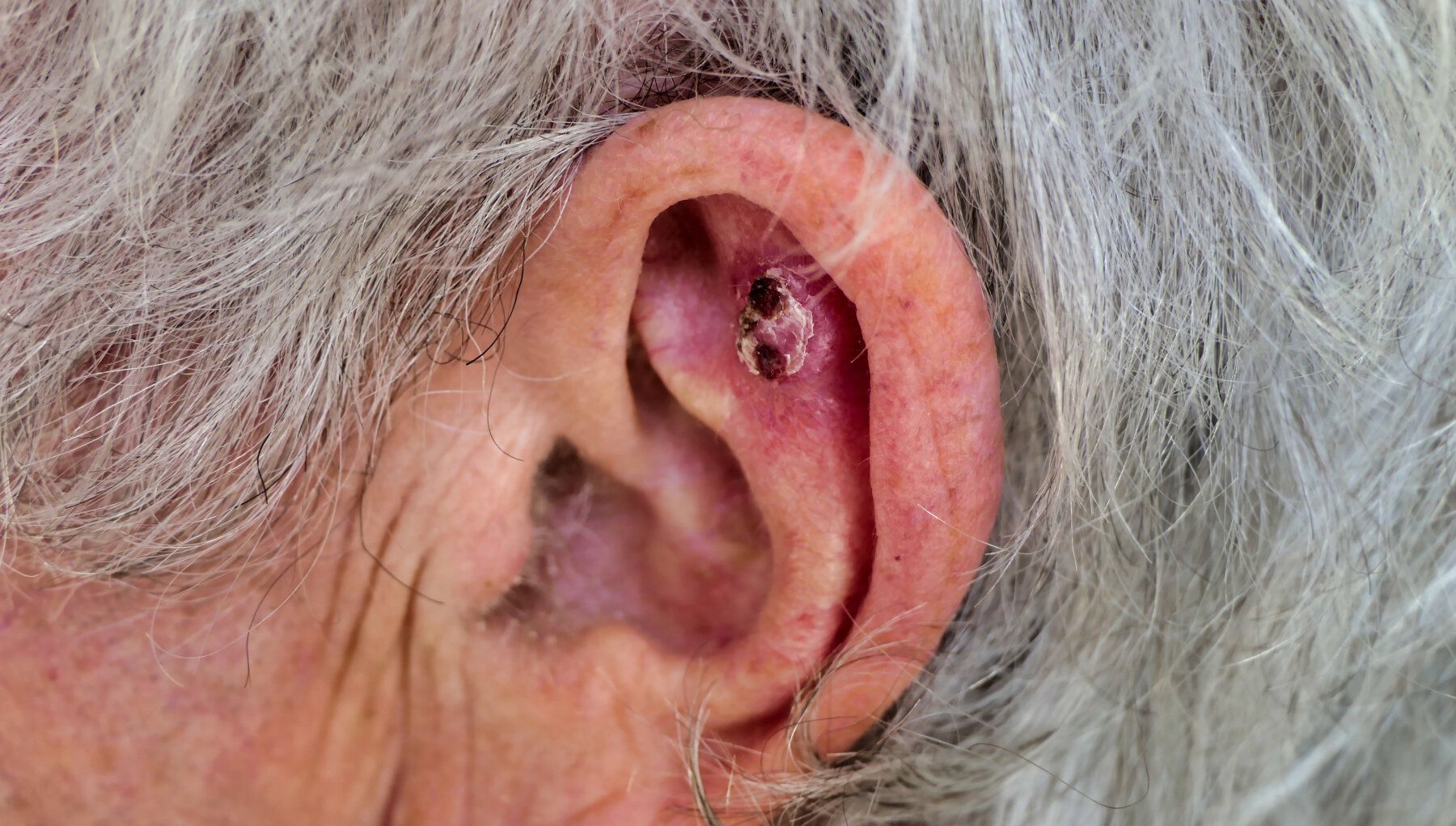 Squamous Cell Carcinoma