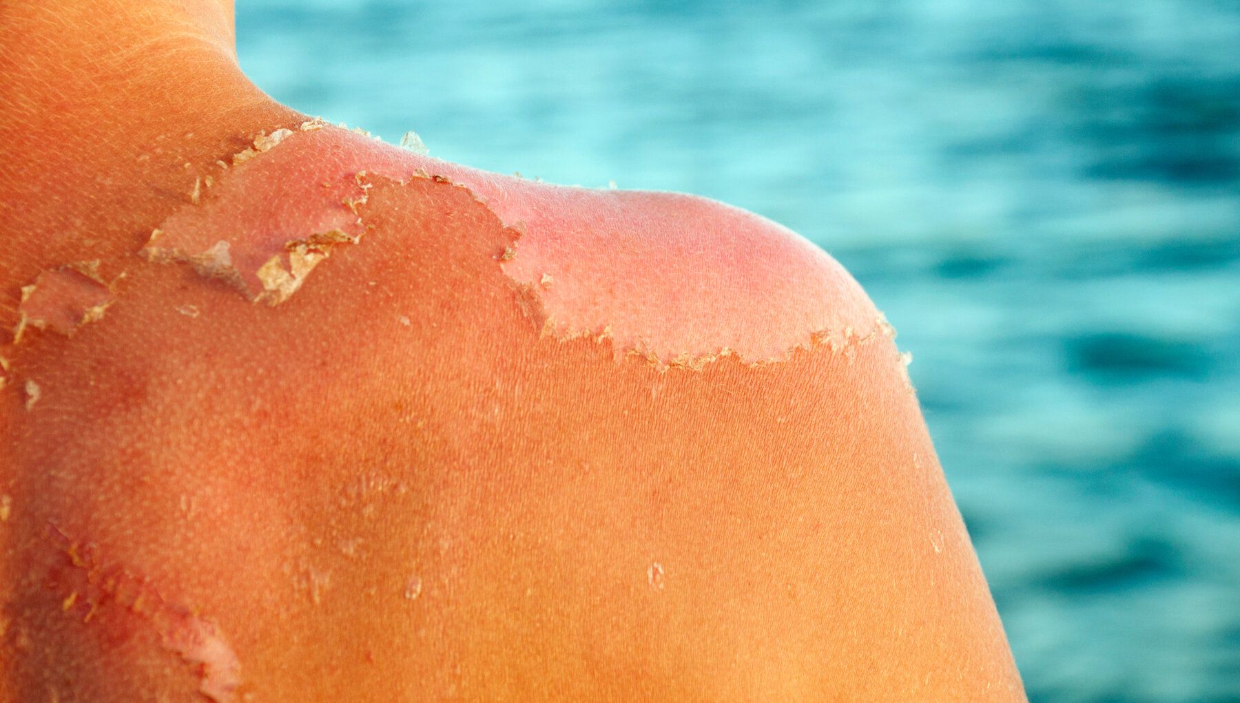 Sun Damage