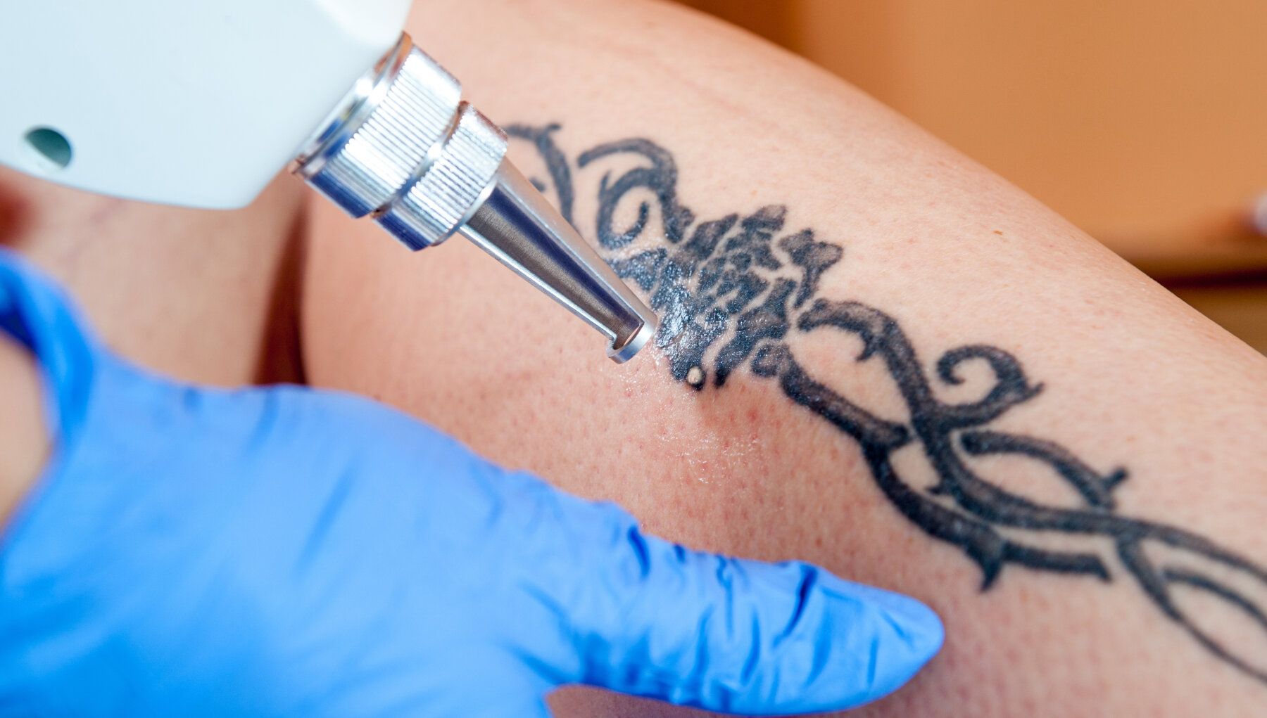 Tattoo Removal