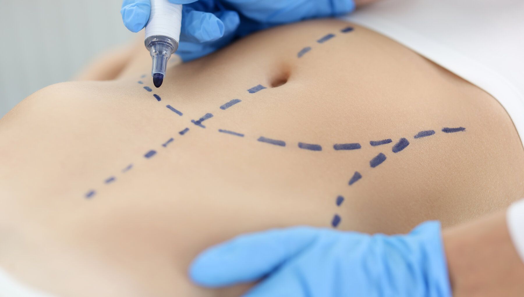 Liposuction vs. Tummy Tuck