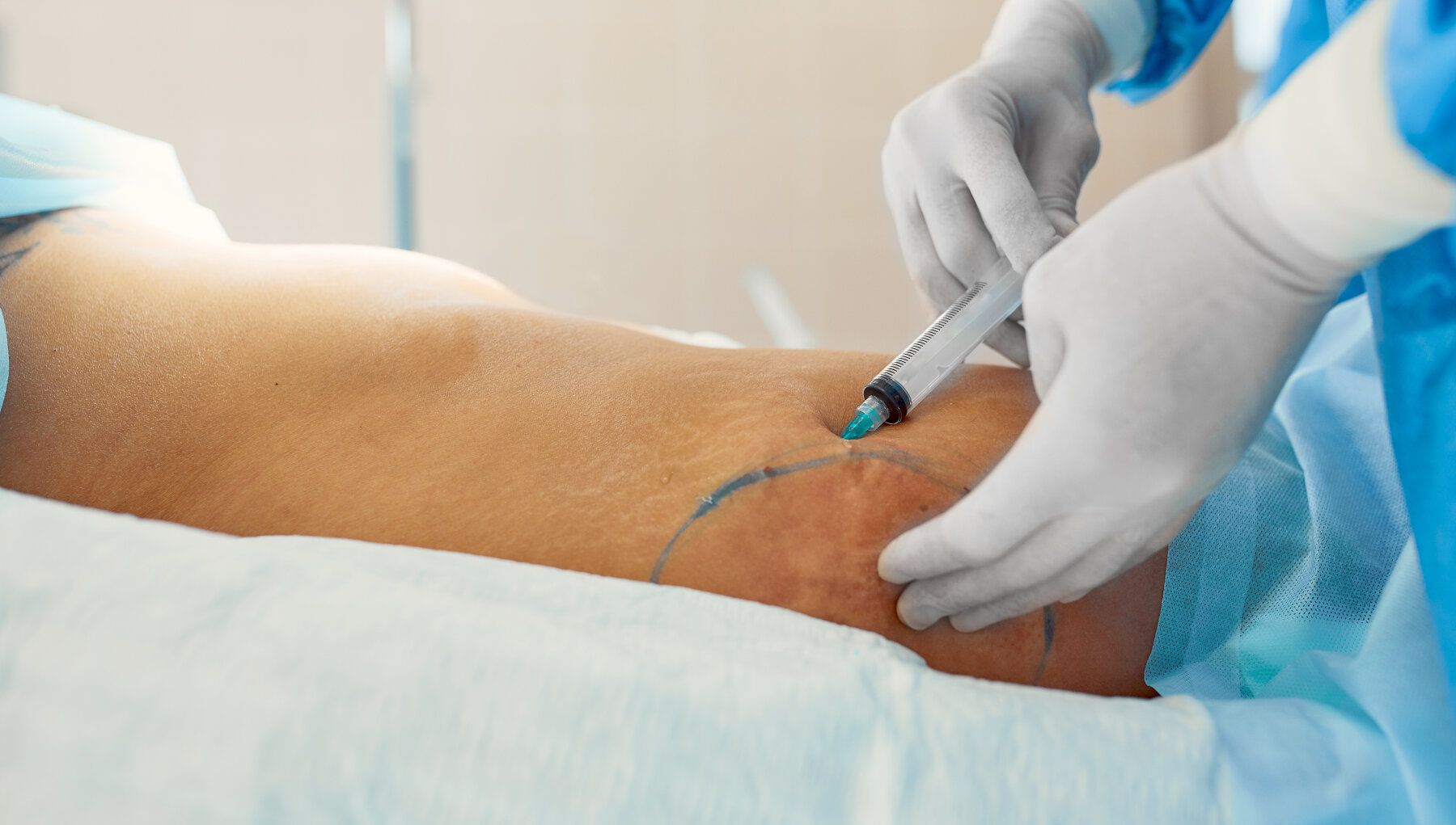 Liposuction