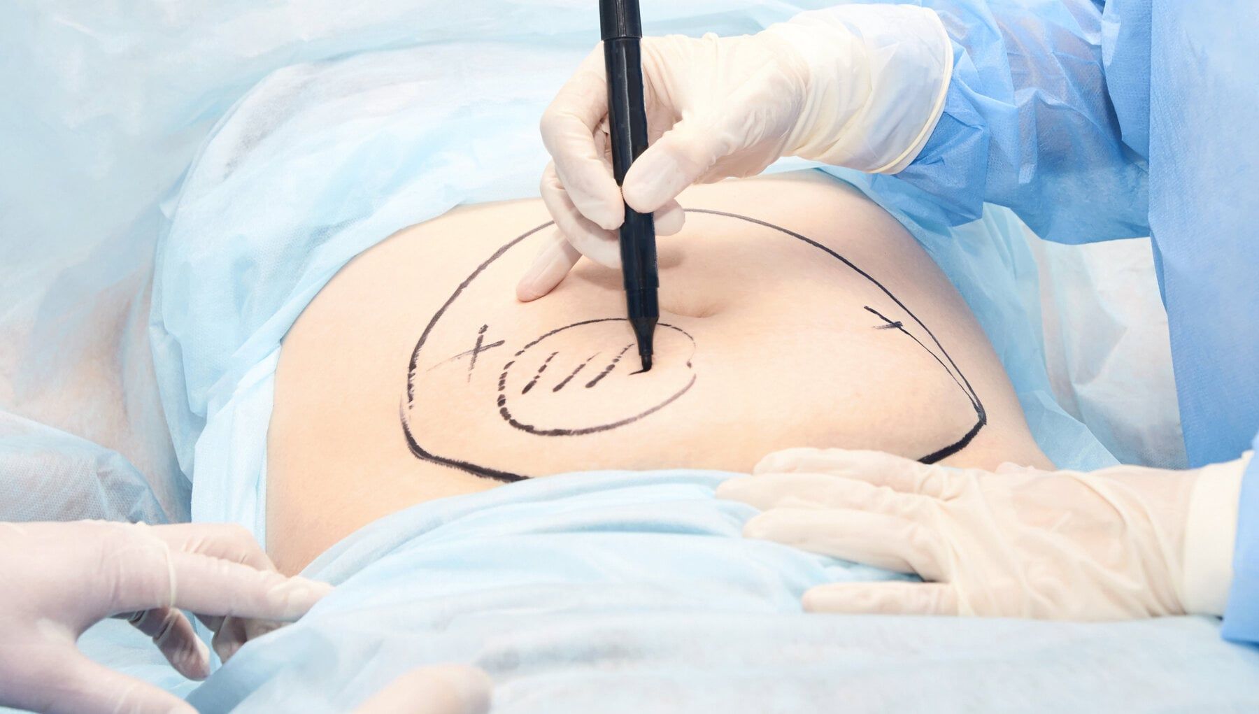 Surgical Body Procedures