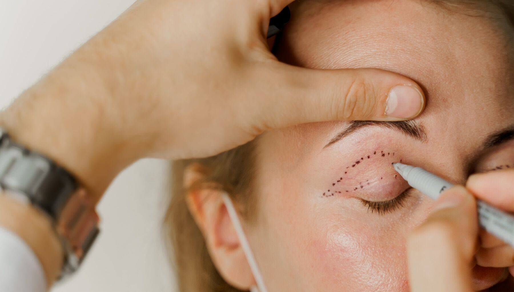 Blepharoplasty