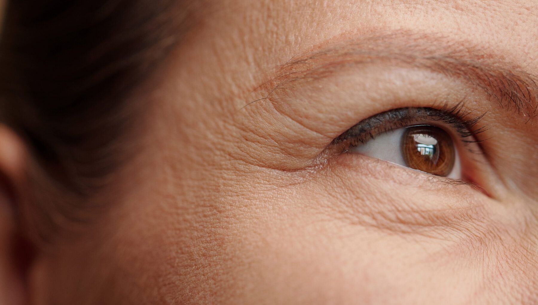 Xeomin® for Wrinkle Reduction