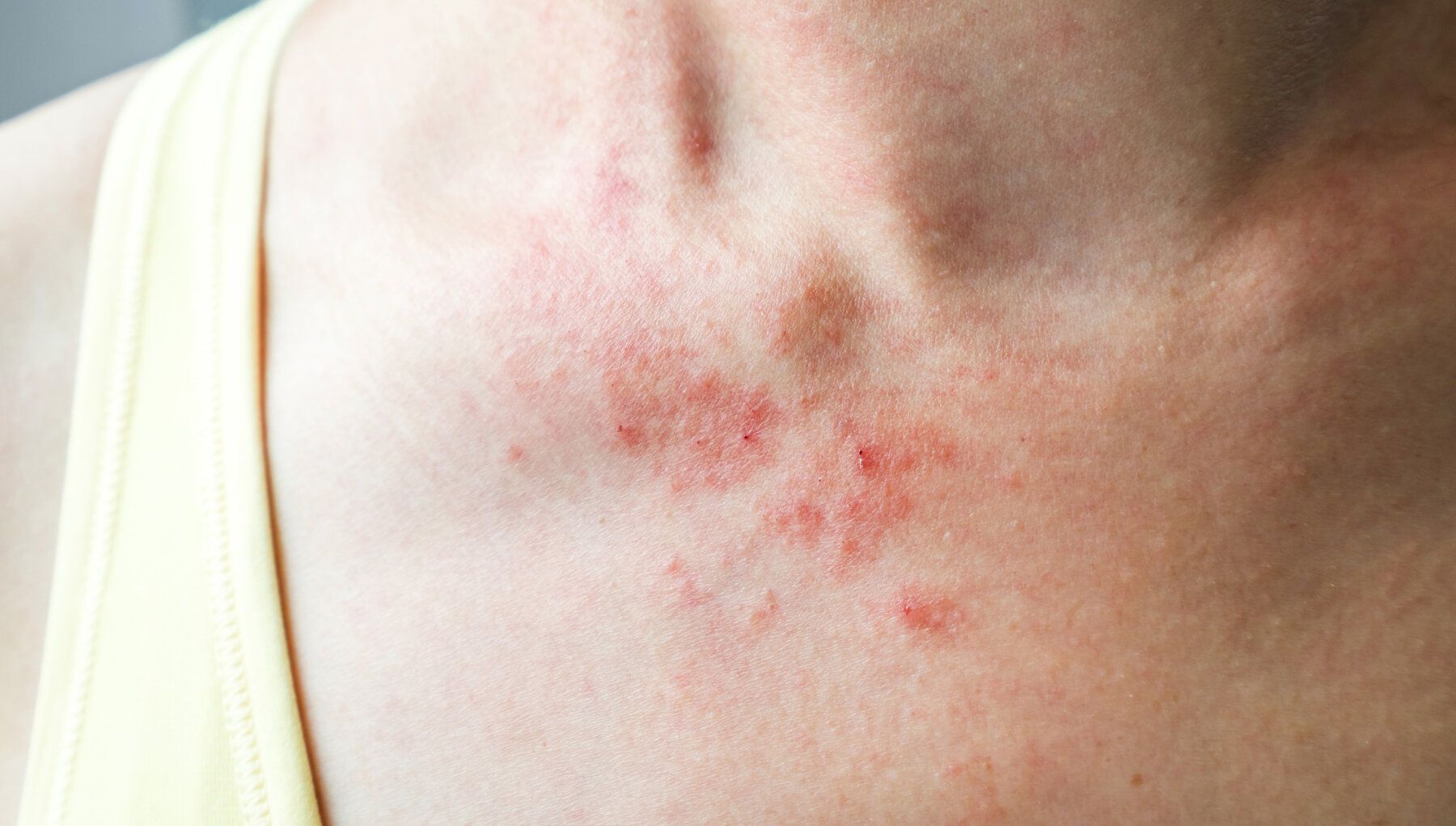Rashes