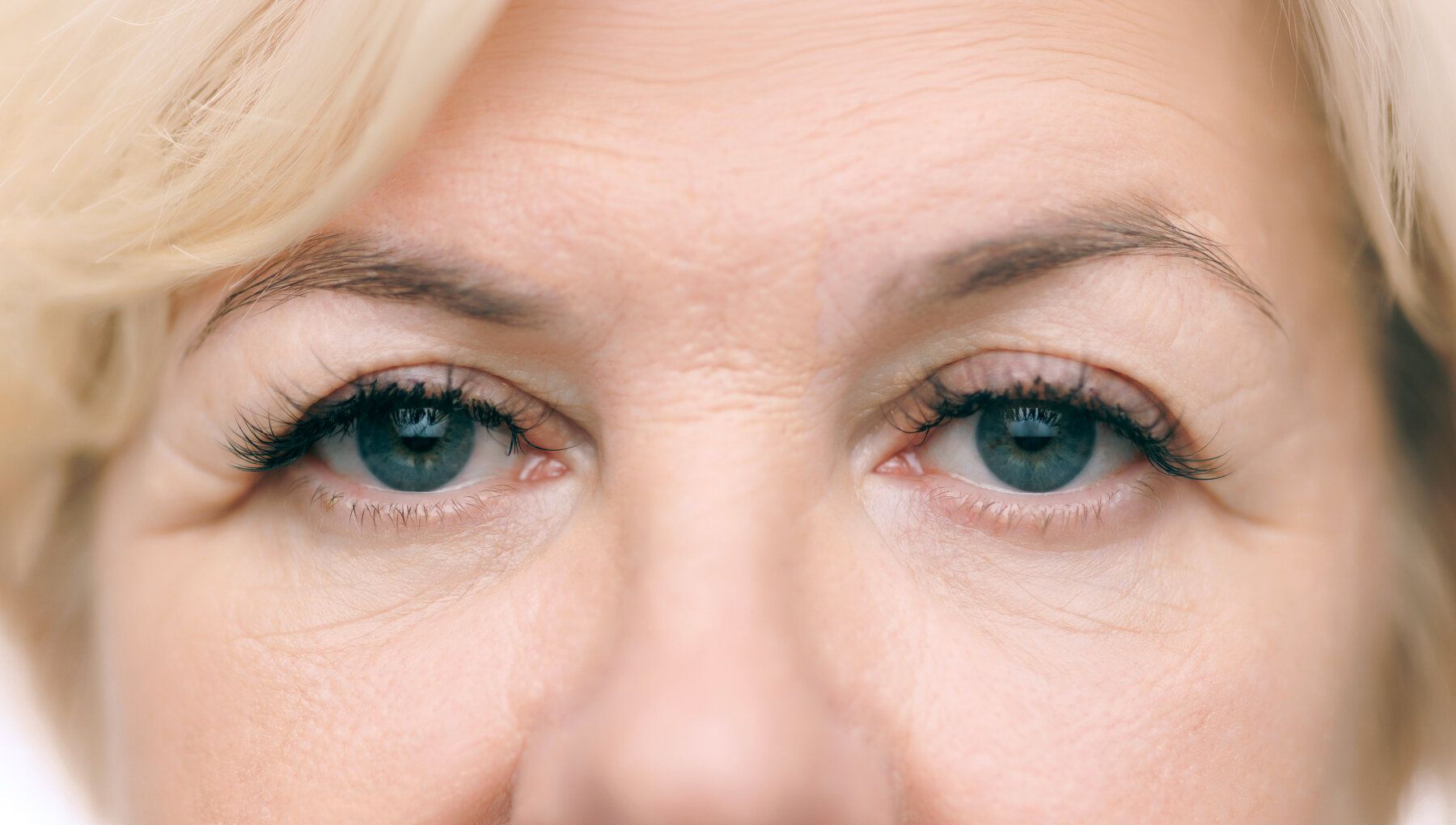 Brow Lift