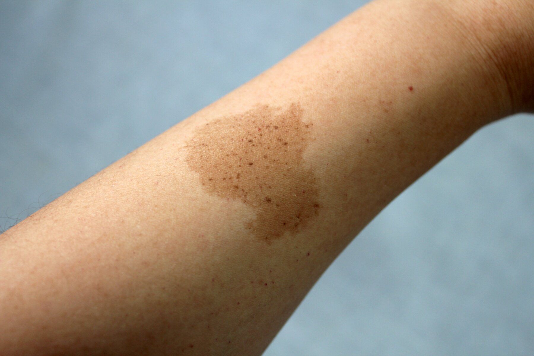 Birthmark