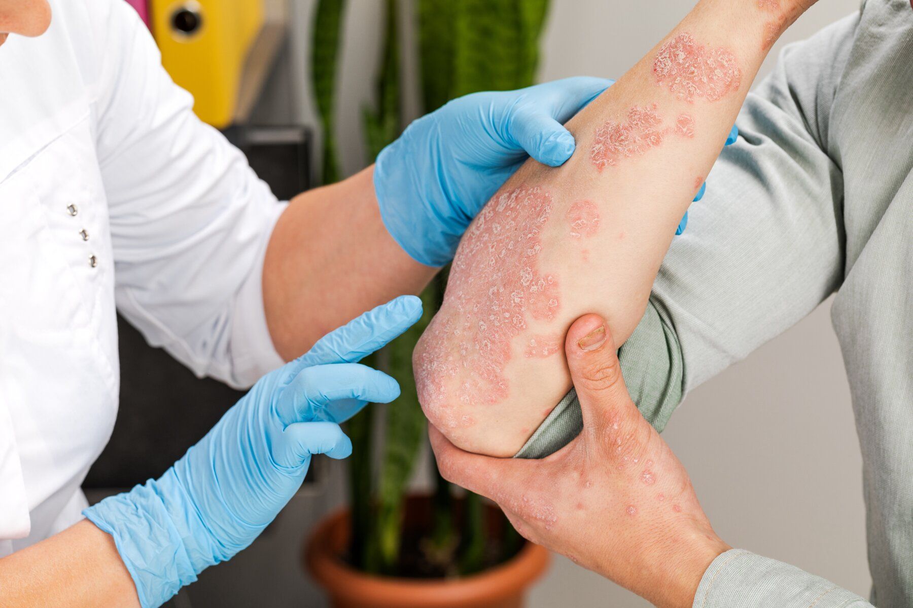 Psoriasis