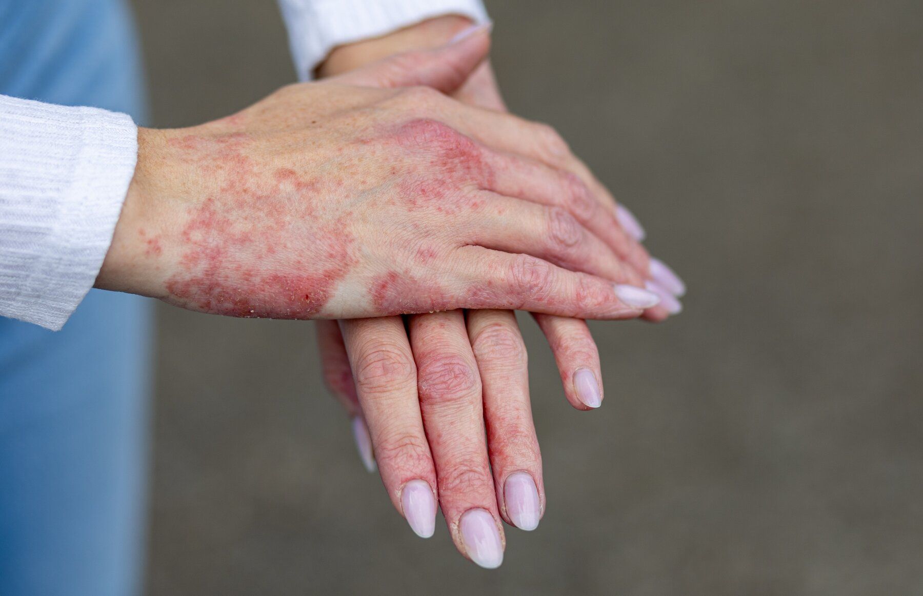 Acne treatment consultation
