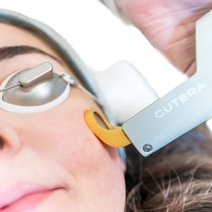 Cutera Titan Laser