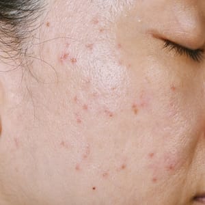 Cutera® Laser Genesis for Acne