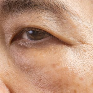 Hooding of the Eye (Ptosis)