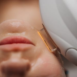 IPL® Photofacial