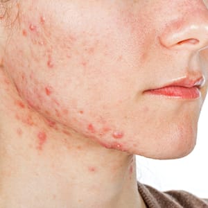 Isotretinoin Acne