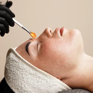 Jessner's Peel