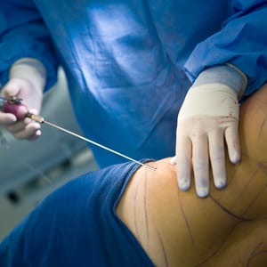 Tumescent Liposuction