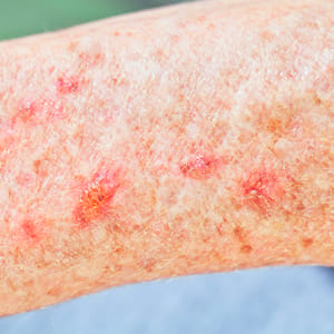 Actinic Keratosis